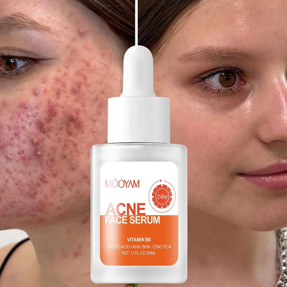 MOOYAM Anti Acne Face Serum – Deep Pore Cleansing Formula for Pimples, Acne Marks, Excess Oil Control and Skin Texture Improvement 30ml
