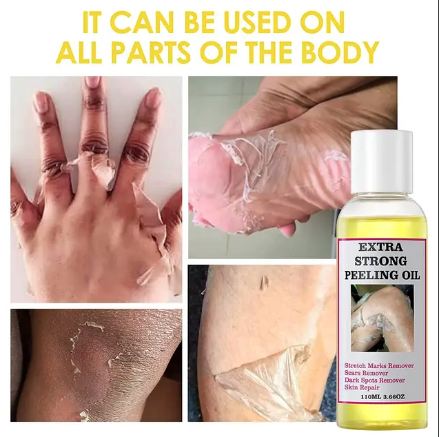 Extra Strong Peeling Oil, Stretch Mark Exfoliating Solution Whitening Oil, Skin Whitening, Stretch Marks Remover, Scar Remover - Image 4