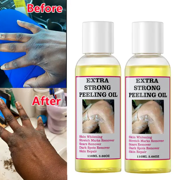 Extra Strong Peeling Oil, Stretch Mark Exfoliating Solution Whitening Oil, Skin Whitening, Stretch Marks Remover, Scar Remover - Image 6